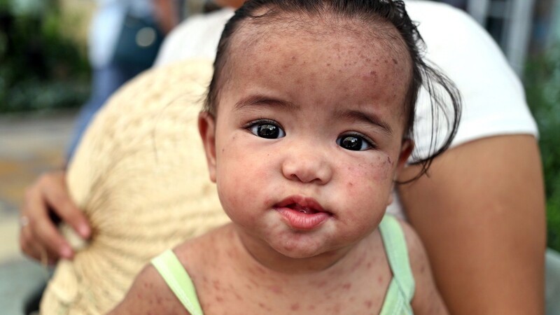 Gegen Masern, eine gefährliche Krankheit mit typischen roten Flecken, wird im kommenden Jahr eine Impfpflicht für Kinder eingeführt.