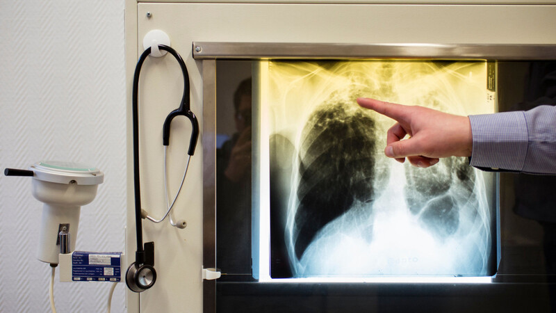 Ein Arzt zeigt einen Tuberkulose-Fall anhand eines Röntgenbildes. Jährlich sterben Millionen Menschen an der Lungenkrankheit.