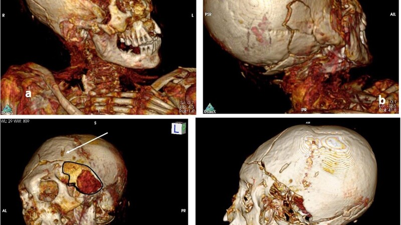 3D-CT-Scan des Schädels der männlichen Mumie aus Délémont. (a-d): Merkmale eines perimortalen Schädeltraumas auf der linken Seite des Schädels mit einer großen perforierenden Läsion im linken Schläfenbereich (Pfeil) und einer in den Schädel verlaufenden Fraktur. (d) zeigt den Bruch des Zygoms auf der linken Seite (Pfeile).