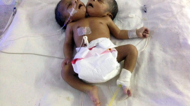 In Bangladesch ist am 11. November ein Baby mit zwei Köpfen zur Welt gekommen.