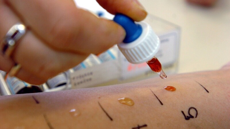 Der Prick-Test ist ein Allergie-Test auf der Haut.