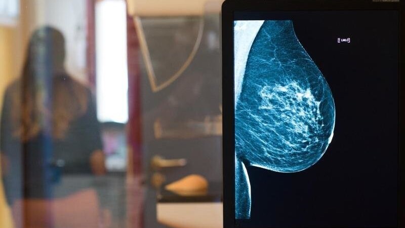 Röntgenbild eines Mammographie-Screening-Programms: In Straubing ist die Untersuchung in der Woche vom 25. bis 29. wieder möglich. (Symbolbild)