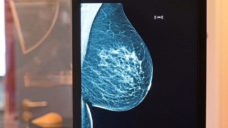 Die gesunde Brust einer Frau auf einer Röntgenaufnahme: Früherkennung erhöht die Heilungschancen um ein Vielfaches.
