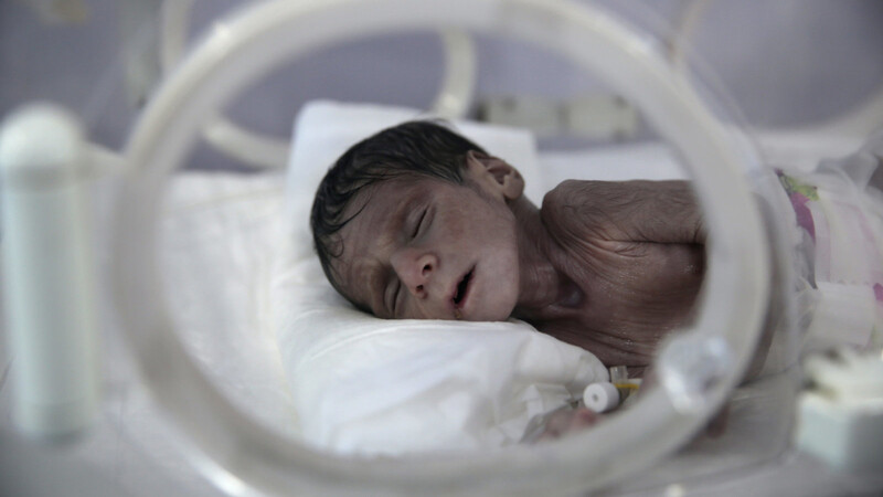 Ein unterernährtes Neugeborenes liegt in einem Inkubator im internationalen Krankenhaus UniMax im jemenitischen Sanaa. Mehr als 800 Millionen Menschen haben nicht genug zu essen. Den Hunger zu beenden, wäre möglich, würde nur einen Bruchteil etwa der weltweiten Rüstungsausgaben kosten, doch es fehlt am politischen Willen.