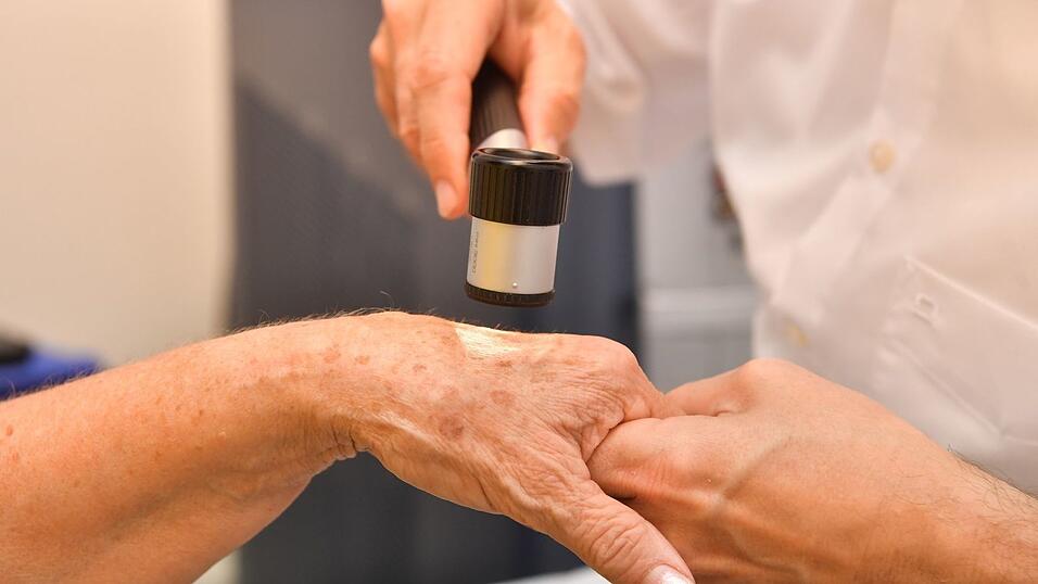 Altersflecken sollten von einem Dermatologen untersuchet werden, um andere Hautveränderungen auszuschließen.