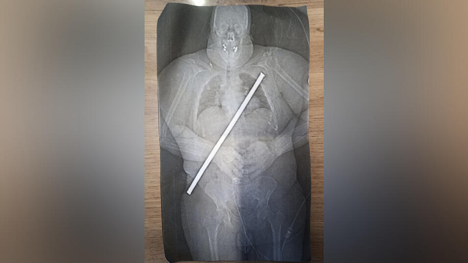 Auch die Ärzte im Klinikum Passau, wo dieses Röntgenbild entstanden ist, hatten noch keinen derartigen Fall. Auch die Ärzte im Klinikum Passau, wo dieses Röntgenbild entstanden ist, hatten noch keinen derartigen Fall.