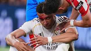 Kylian Mbapp&eacute; wurde im Spiel gegen Girona im Gesicht getroffen.