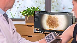 Bei der digitalen Videodermatoskopie wird die Aufnahme mit Millionen anderer Aufnahmen verglichen. Die KI gibt dann Informationen zum Entwicklungsstatus und möglichen Therapien.