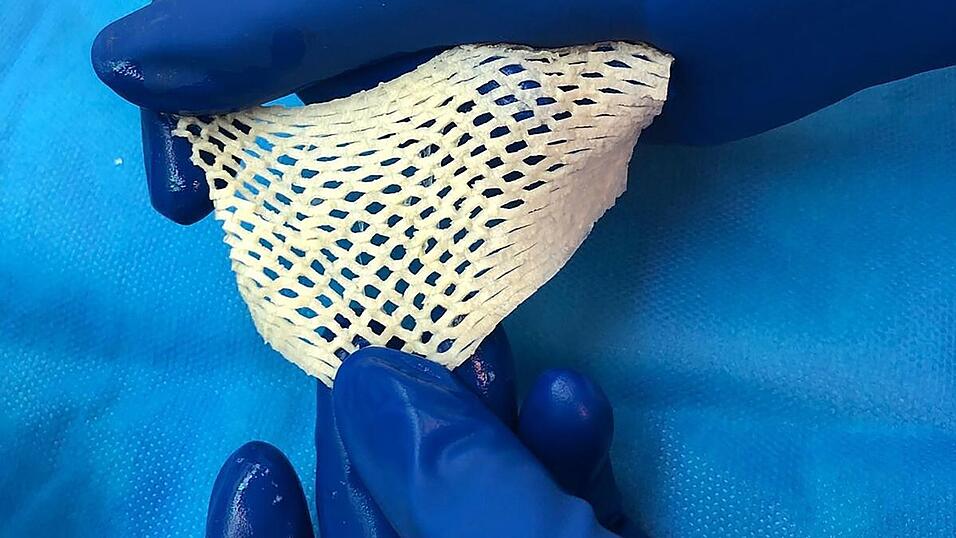 Wichtige Alternative f&uuml;r Hautttansplantationen: Fischhaut.