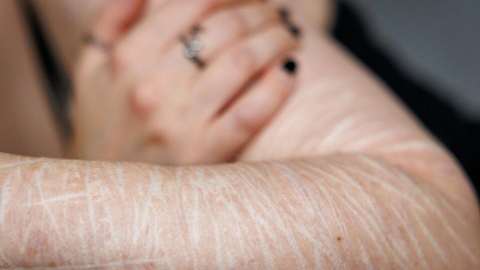 Borderline-Patienten leiden unter starken Gefühls- und Stimmungsschwankungen und verletzen sich häufig selbst, um die innere Anspannung zu verringern. Borderline-Patienten leiden unter starken Gefühls- und Stimmungsschwankungen und verletzen sich häufig selbst, um die innere Anspannung zu verringern.