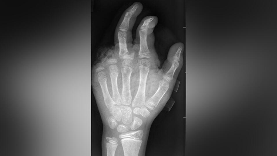So kann ein R&ouml;ntgenbild nach einer missgl&uuml;ckten B&ouml;llerexplosion aussehen: Zwei Finger fehlen.