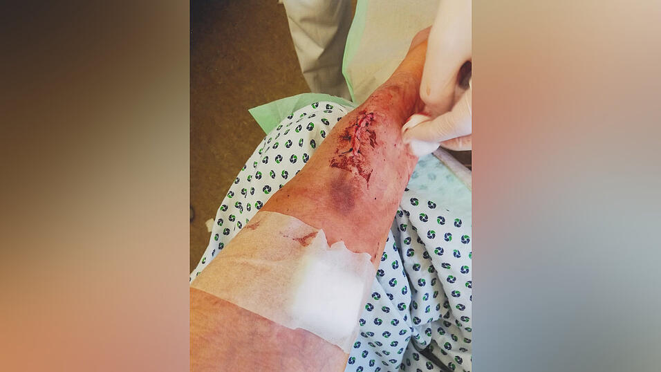 Kein kleiner Piks, sondern ein Zugang für dicke Nadeln. Für den Shunt müssen in einer Operation zwei Blutgefäße zusammengeführt werden. Kein kleiner Piks, sondern ein Zugang für dicke Nadeln. Für den Shunt müssen in einer Operation zwei Blutgefäße zusammengeführt werden.