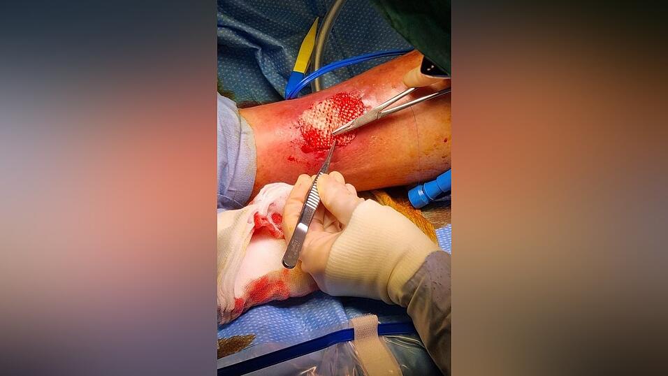 Das Omega-3 in der Fischhaut f&ouml;rdert die Heilung gro&szlig;er Wunden.