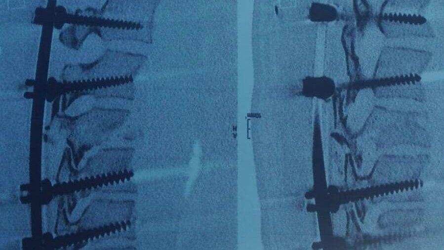 Titanplatten halten seine Wirbelsäule zusammen.