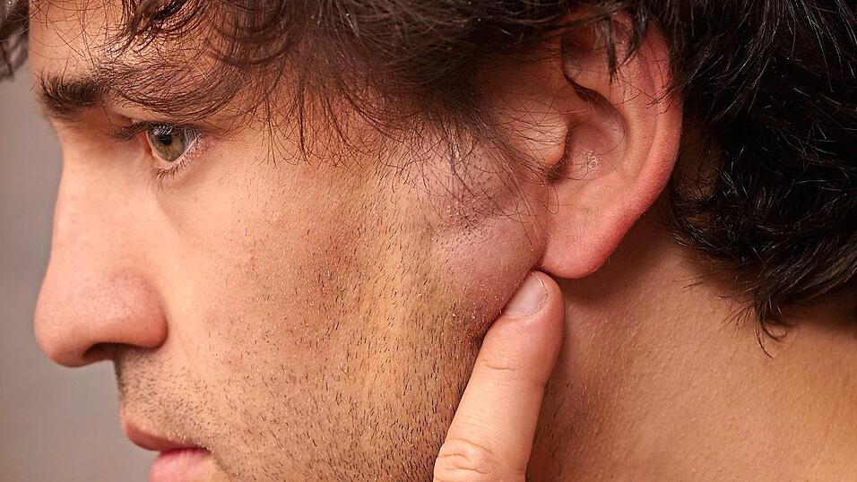 Lipome liegen für gewöhnlich im Unterhautfettgewebe. Sie können sogar Kindskopfgröße erreichen. Lipome liegen für gewöhnlich im Unterhautfettgewebe. Sie können sogar Kindskopfgröße erreichen.