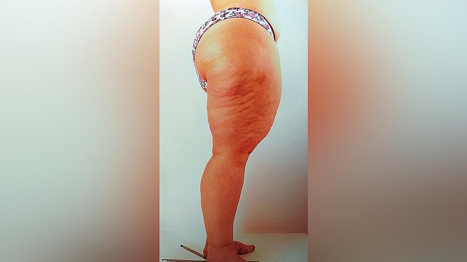 Susanne H. stellt sich 2018 bei einer auf Liposuktionen spezialisierten Klinik in M&uuml;nchen vor, die zu den f&uuml;hrenden in der Lip&ouml;demforschung geh&ouml;rt. H. plant zwei Operationen, die sie selbst finanziert.