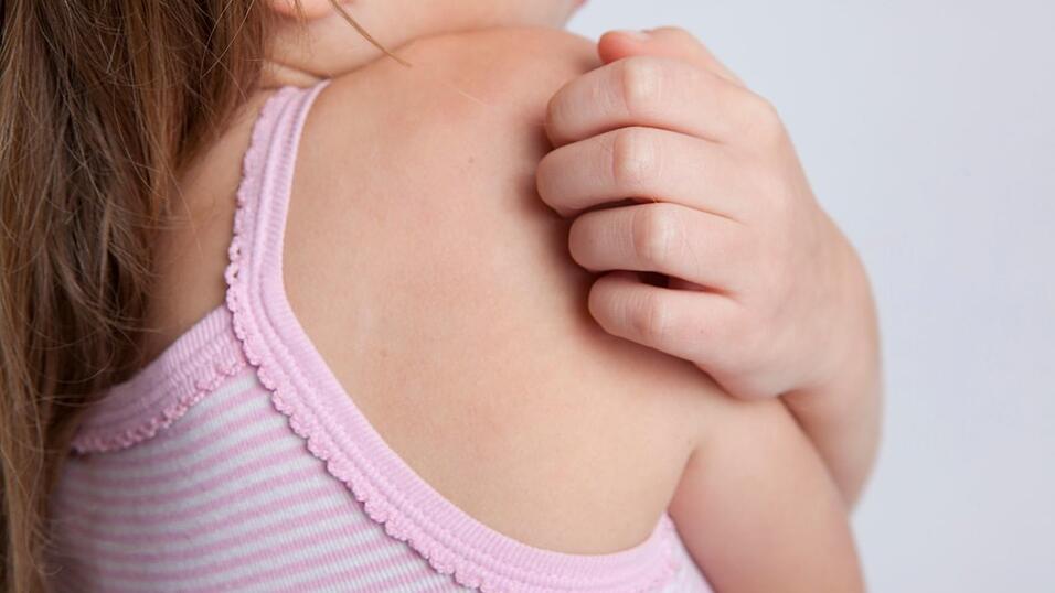 Besonders Kinder reagieren sehr empfindlich, und der dauerhafte Juckreiz stört die Nachtruhe.