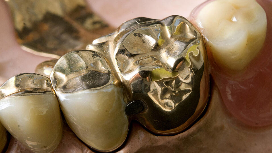 Eine Zahnprothese, die zum Teil aus Gold besteht, hat einen betr&auml;chtlichen Wert.