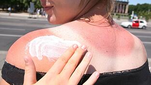 Sonnenbrand kann zu Hautproblemen wie Falten und Altersflecken führen.