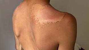 Zu lange in der Sonne: Das kann langfristig weit schlimmere Folgen haben als nur einen Sonnenbrand.