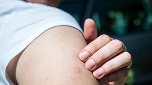 M&uuml;ckenstiche sollte man nicht aufkratzen. Die Wunde k&ouml;nnte sich sonst entz&uuml;nden.