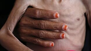 Viele von der Hungerkrise betroffene Länder machen keine Fortschritte bei der Verbesserung der Lage.