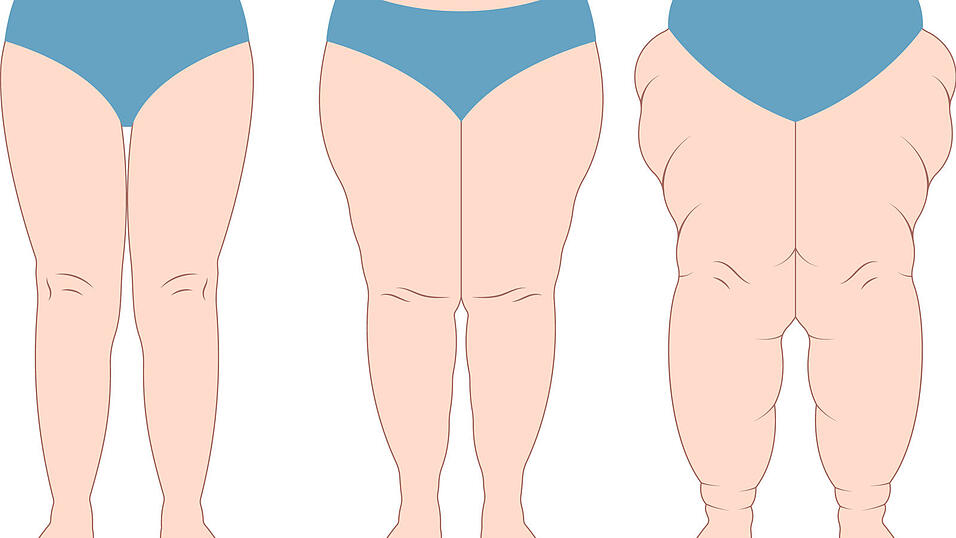 Stadien einer Krankheit: So kann ein Lipödem in den Phasen 1 (links) bis 3 (rechts) aussehen. Stadien einer Krankheit: So kann ein Lipödem in den Phasen 1 (links) bis 3 (rechts) aussehen.