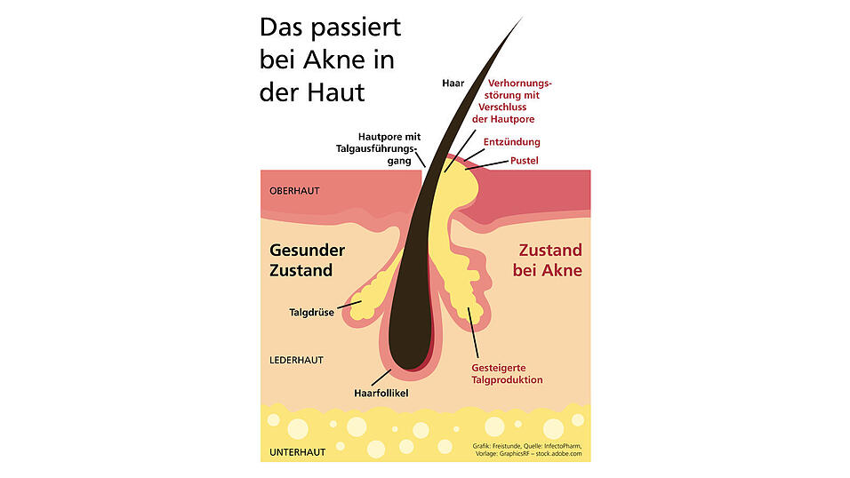 Die Talgdrüsen in unserer Haut produzieren Talg, der dann über die Hautoberfläche abfließt. Das ist eigentlich ein normaler Vorgang bei jedem Menschen. Allerdings kann es dazu kommen, dass die Talgproduktion gestört wird. Das kann zum Beispiel in der Pubertät oder nach den Wechseljahren der Fall sein. Besonders in der Pubertät produzieren die Talgdrüsen in der Haut vermehrt Talg. Gleichzeitig kommt es zu einer Verhornungsstörung. Das heißt, abgestorbene Hautschuppen können nicht mehr abtransportiert werden und dadurch die Talgdrüse verstopfen. Der Talg kann dann nicht mehr wie gewohnt abfließen und es entstehen Entzündungen. Akne zeigt sich deswegen auch dort, wo sich viele Talgdrüsen befinden: im Gesicht, auf den Schultern und dem Nacken sowie auf Brust/Dekolleté und Rücken. Die Talgdrüsen in unserer Haut produzieren Talg, der dann über die Hautoberfläche abfließt. Das ist eigentlich ein normaler Vorgang bei jedem Menschen. Allerdings kann es dazu kommen, dass die Talgproduktion gestört wird. Das kann zum Beispiel in der Pubertät oder nach den Wechseljahren der Fall sein. Besonders in der Pubertät produzieren die Talgdrüsen in der Haut vermehrt Talg. Gleichzeitig kommt es zu einer Verhornungsstörung. Das heißt, abgestorbene Hautschuppen können nicht mehr abtransportiert werden und dadurch die Talgdrüse verstopfen. Der Talg kann dann nicht mehr wie gewohnt abfließen und es entstehen Entzündungen. Akne zeigt sich deswegen auch dort, wo sich viele Talgdrüsen befinden: im Gesicht, auf den Schultern und dem Nacken sowie auf Brust/Dekolleté und Rücken.