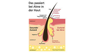 Die Talgdrüsen in unserer Haut produzieren Talg, der dann über die Hautoberfläche abfließt. Das ist eigentlich ein normaler Vorgang bei jedem Menschen. Allerdings kann es dazu kommen, dass die Talgproduktion gestört wird. Das kann zum Beispiel in der Pubertät oder nach den Wechseljahren der Fall sein. Besonders in der Pubertät produzieren die Talgdrüsen in der Haut vermehrt Talg. Gleichzeitig kommt es zu einer Verhornungsstörung. Das heißt, abgestorbene Hautschuppen können nicht mehr abtransportiert werden und dadurch die Talgdrüse verstopfen. Der Talg kann dann nicht mehr wie gewohnt abfließen und es entstehen Entzündungen. Akne zeigt sich deswegen auch dort, wo sich viele Talgdrüsen befinden: im Gesicht, auf den Schultern und dem Nacken sowie auf Brust/Dekolleté und Rücken.