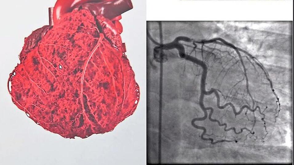 Der Herzmuskel wird von den Herzkranzgef&auml;&szlig;en mit Blut versorgt. Mit MRT-Aufnahmen k&ouml;nnen &Auml;rzte erkennen, ob das Organ gut durchblutet und frei von Entz&uuml;ndungen ist. Covid-Patienten erleiden w&auml;hrend ihrer Infektion bis zu 20 mal h&auml;ufiger eine Herzmuskelentz&uuml;ndung, als Impflinge nach der 2. Spritze.